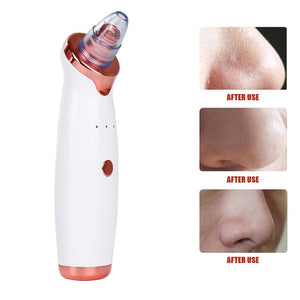 The PoreVac - Blackhead Remover